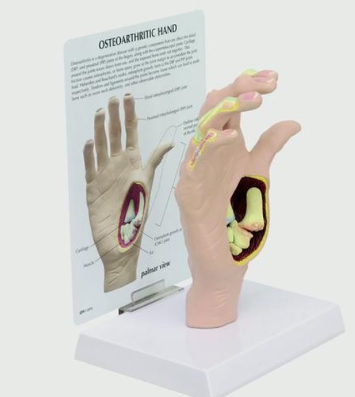 Model ruky s osteoartrózou