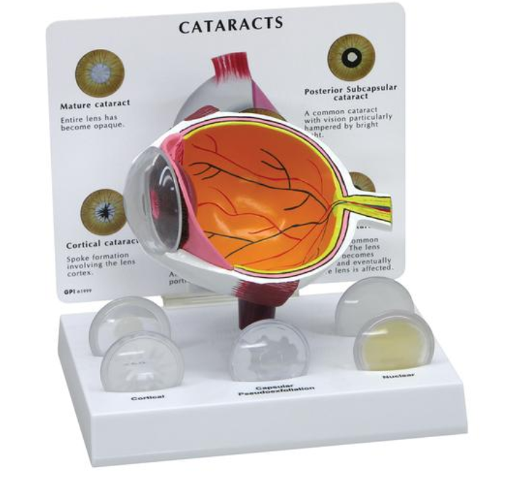 Kataraktové oko