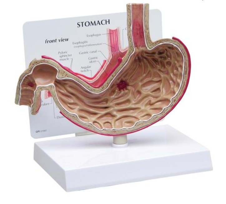 Model žaludku s vředy